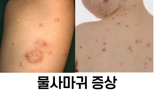  물 사마귀의 원인 및 치료법은?