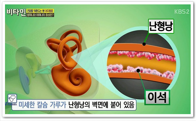  이석증 증상과 원인 운동법 정리