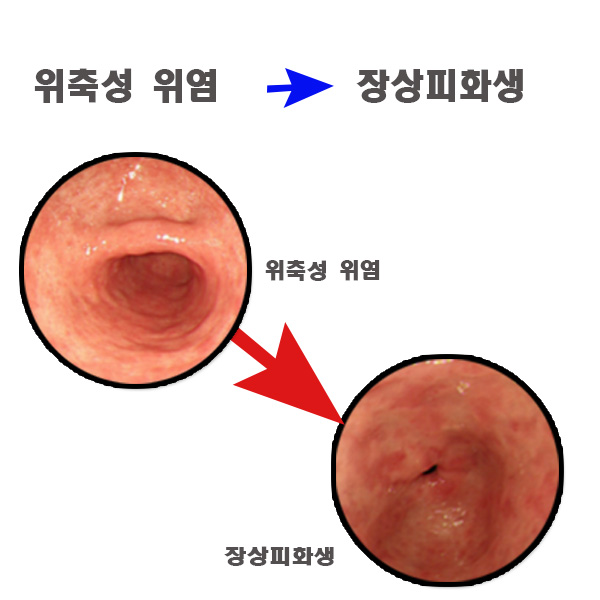 위축성 위염에서 장상피화생으로 변하는 모습