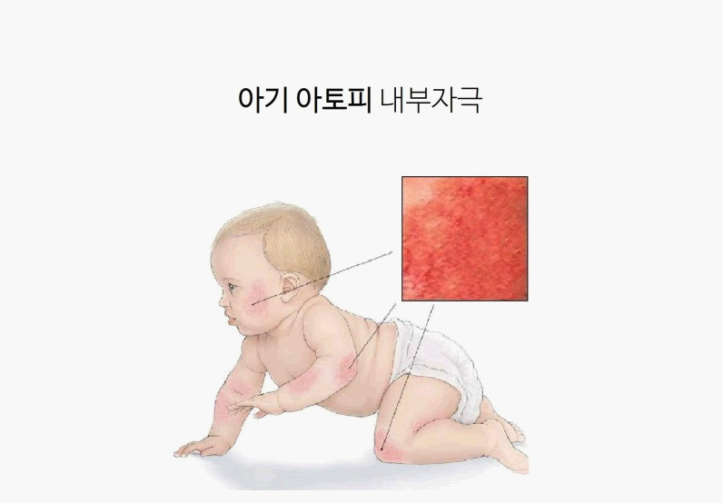 신생아 아토피 이미지