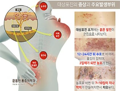 대상포진 초기증상