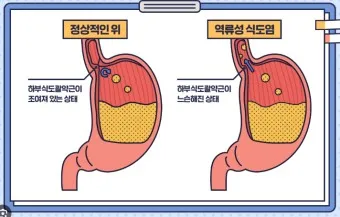 역류성 식도염 원인 초기증상 예방하는 방법_5