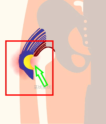 고관절 활액낭염 골반 위치 모습
