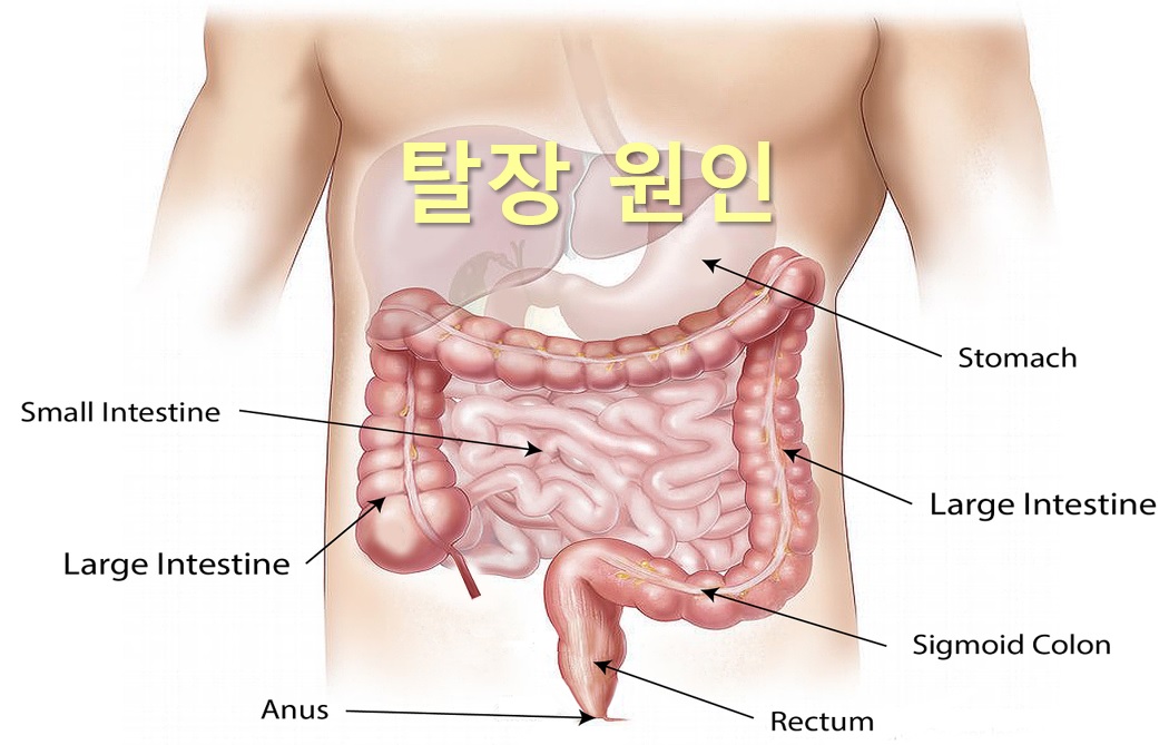  탈장 원인과 탈장 수술 후 관리 방법