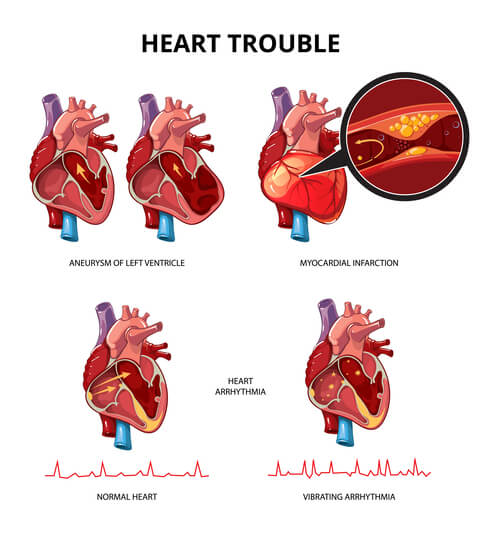 Heart-disease- infographics