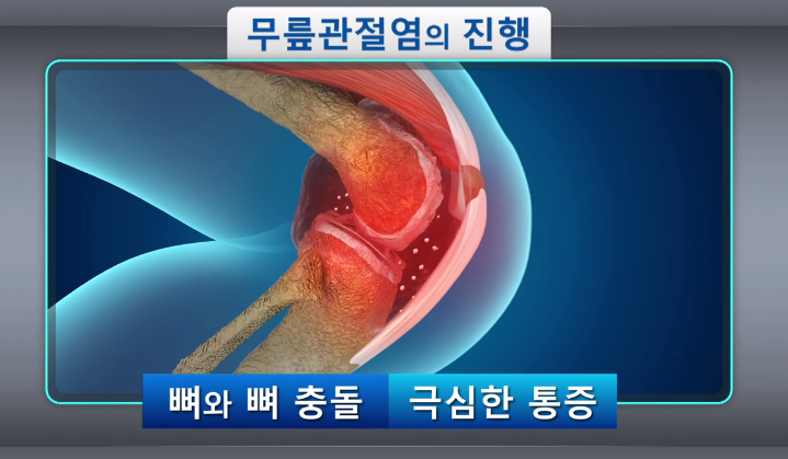 보스웰리아의 관절염 억제 효과