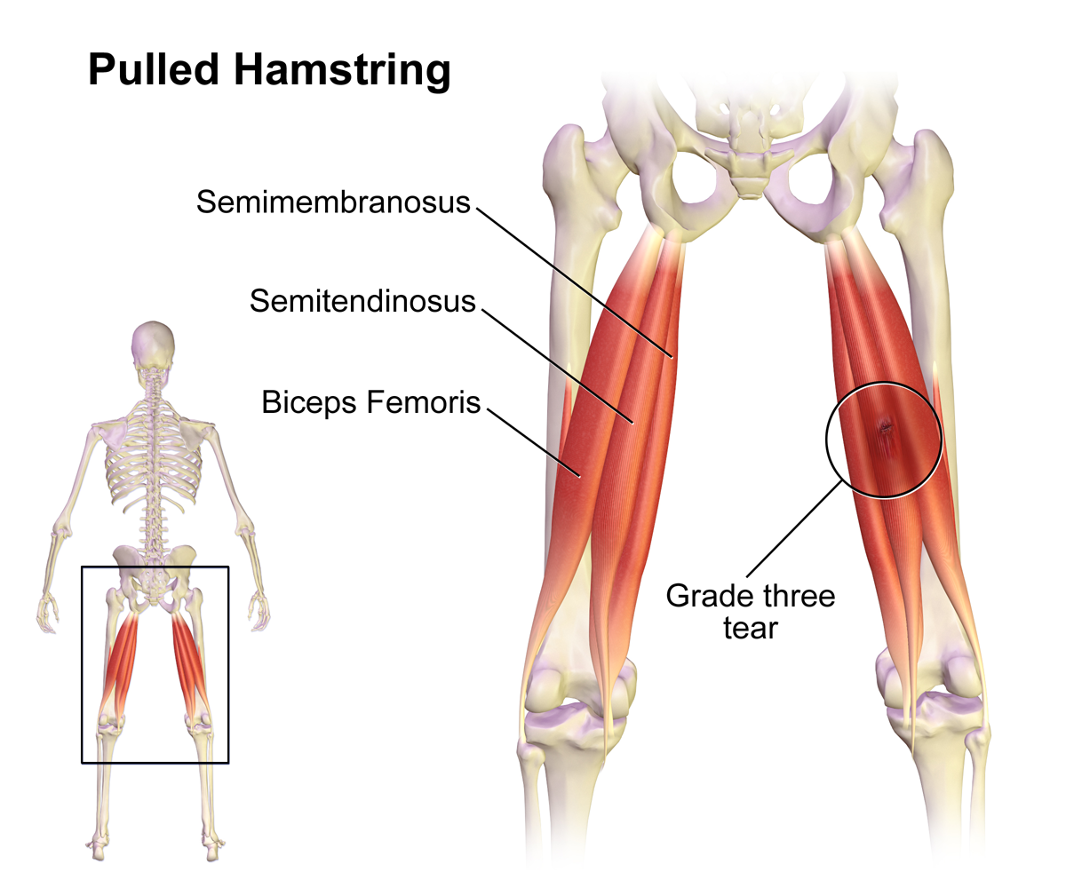 오금통증을 일으키는 비복근과 햄스트링의 근육 그림