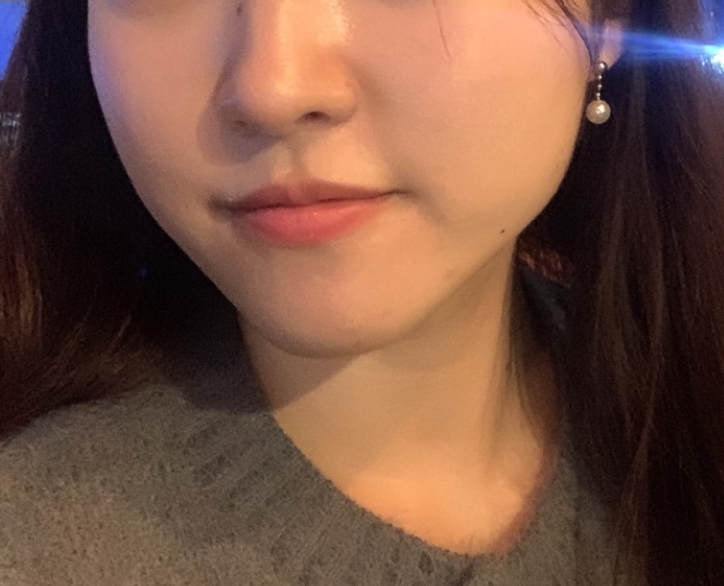  광대보톡스 후기, 이거 모르면 후회함..