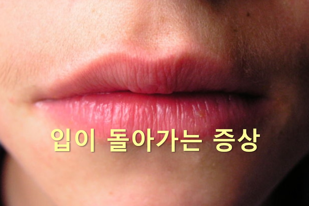  입이 돌아가는 이유와 입이 돌아가는 증상 질환