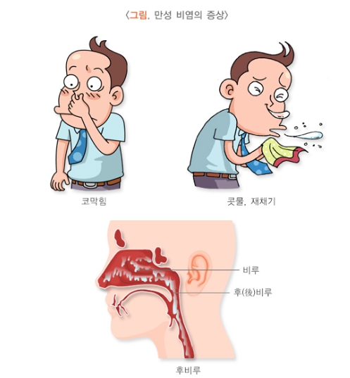 만성비염의-증상