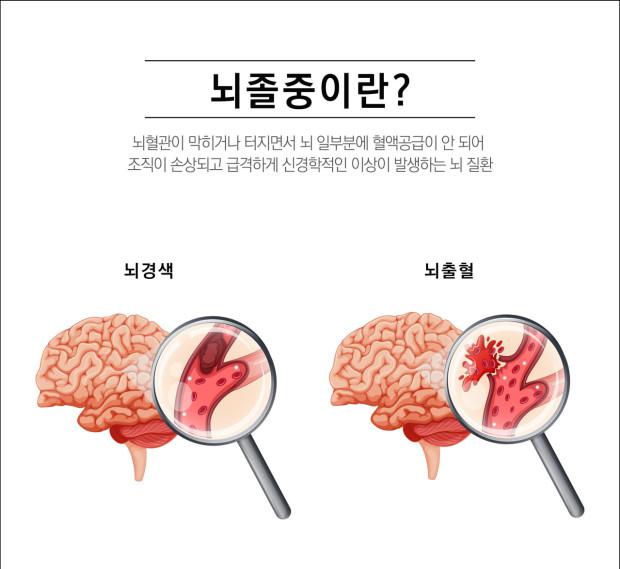 뇌졸중 전조증상과 체크리스트 및 예방과 치료