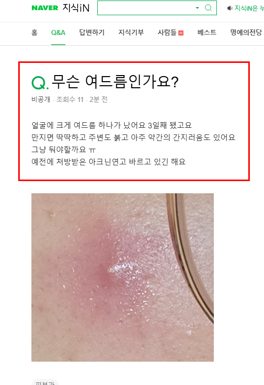 여드름 관련 질문 지식인