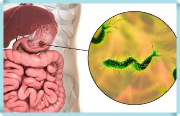 헬리코박터균 증상 해결