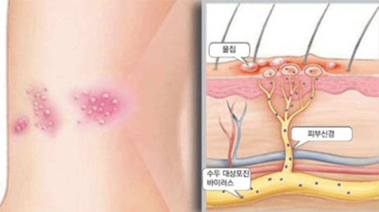 신경절과-피부-물집-위치