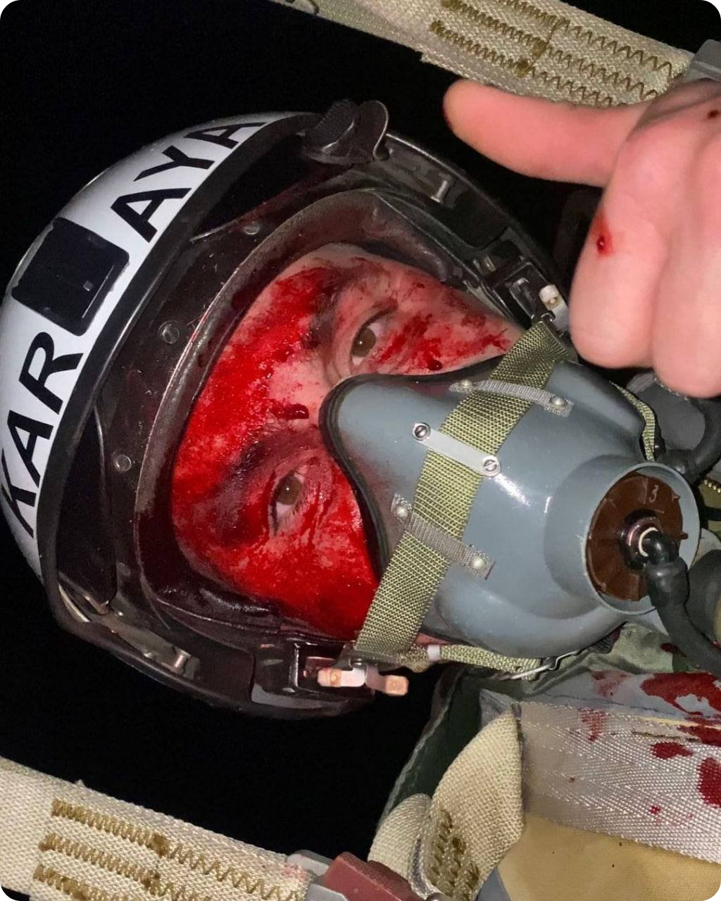 목에 상처를 입은 우크라이나 공군 조종사 Vadym