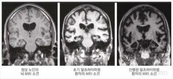 알츠하이머와 치매 차이_22