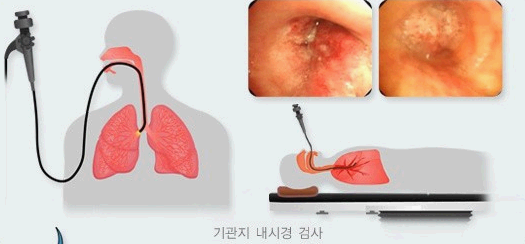 기관지 내시경 검사