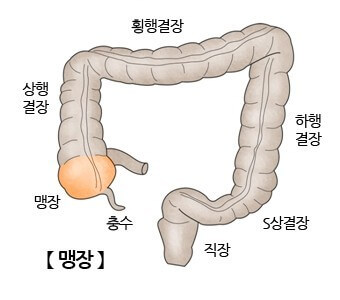 맹장염 초기 증상 5가지 및 맹장 위치