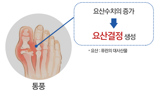 요산결정과-통풍