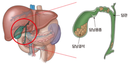 급성 췌장염
