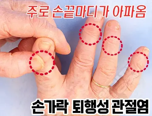 손가락-퇴행성-관절염이-있으면-주로-손끝-마디에서-통증이-발생합니다.