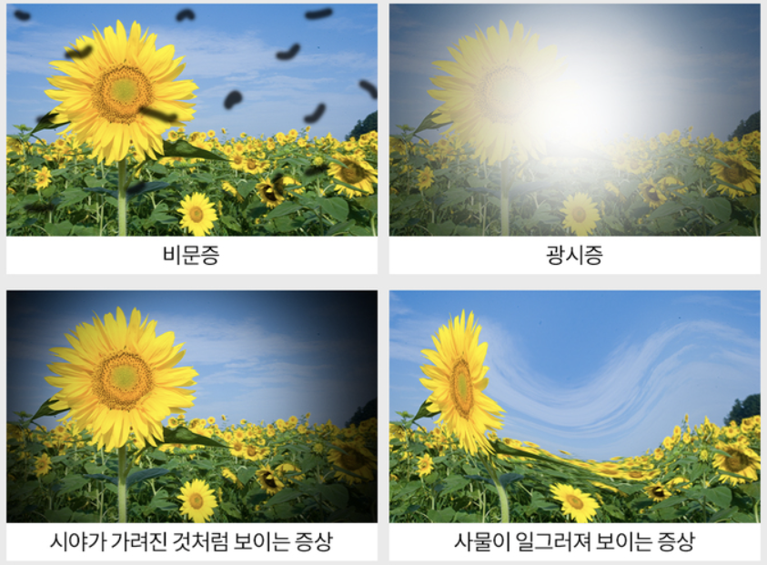 망막박리