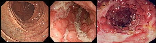 크론병 대장 내시경 사진 (정상&#44; 크론병 대장 내시경 사진 1&#44;2)