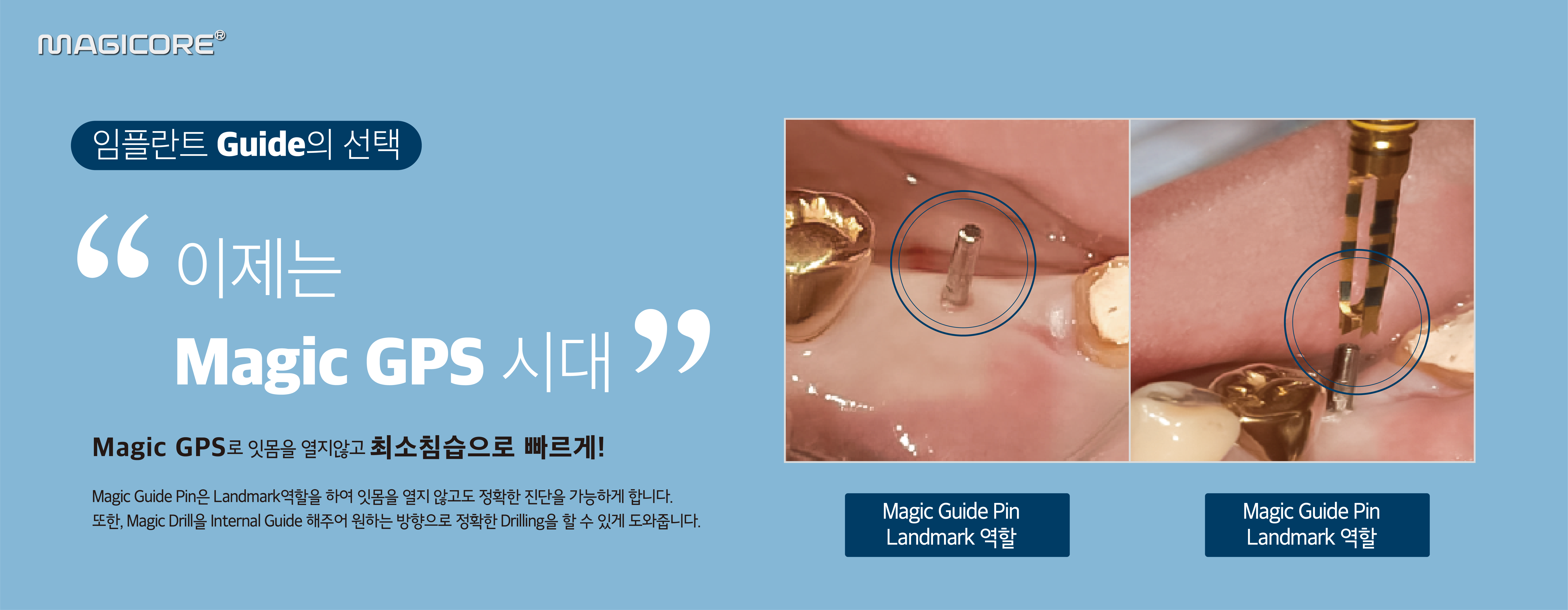  하월곡동치과 다사랑치과에서 IBS임플란트로 통증 걱정을 줄여보세요!