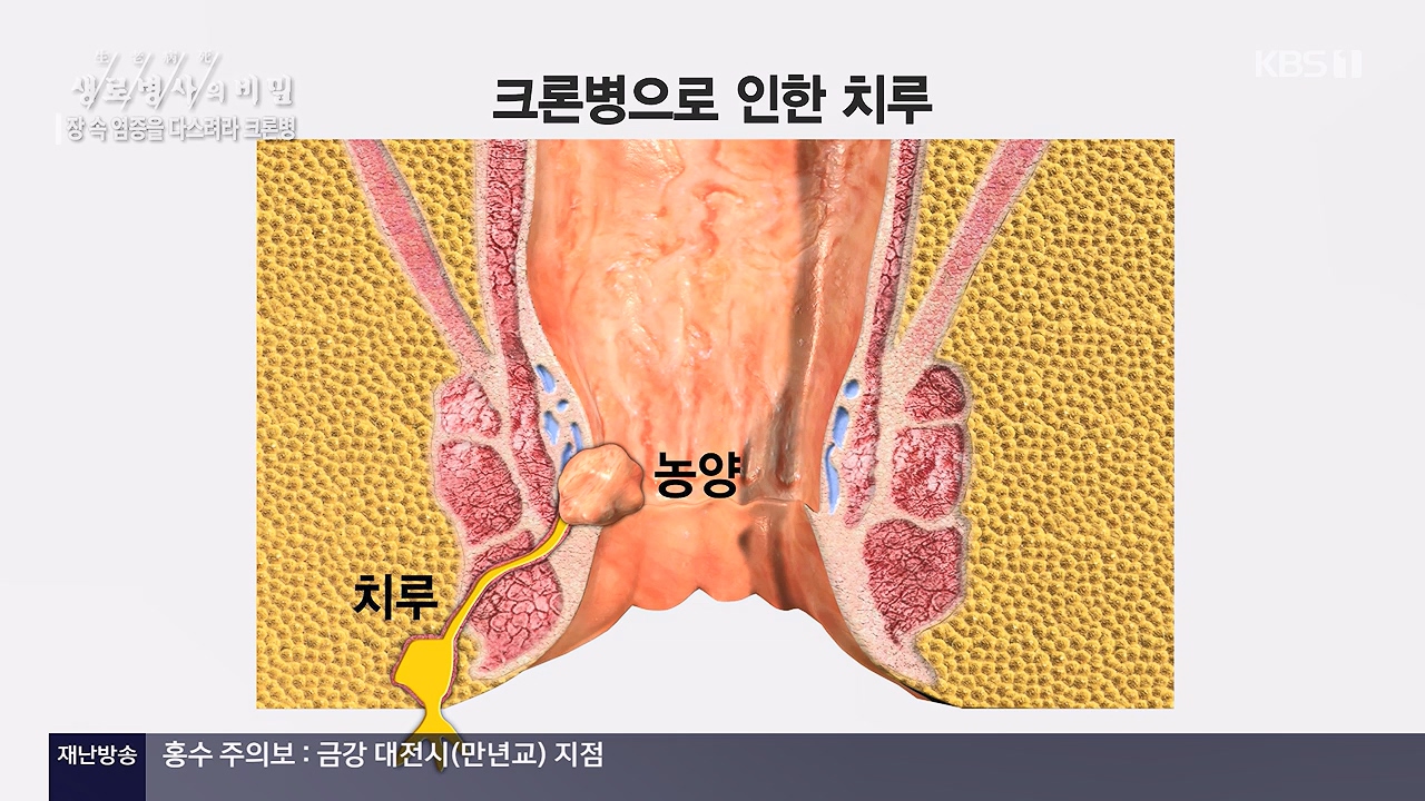 생로병사의 비밀.E884.230921p-NEXT.mp4_20230921_204733.261.jpg
