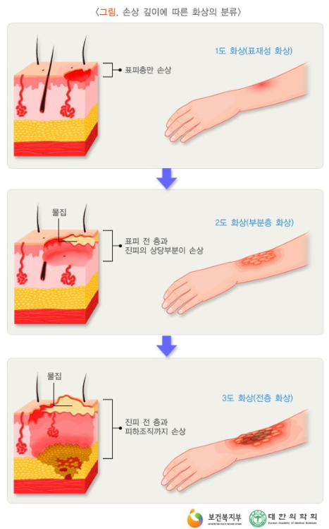  손 화상 _  우리 손이 위험해요 !!