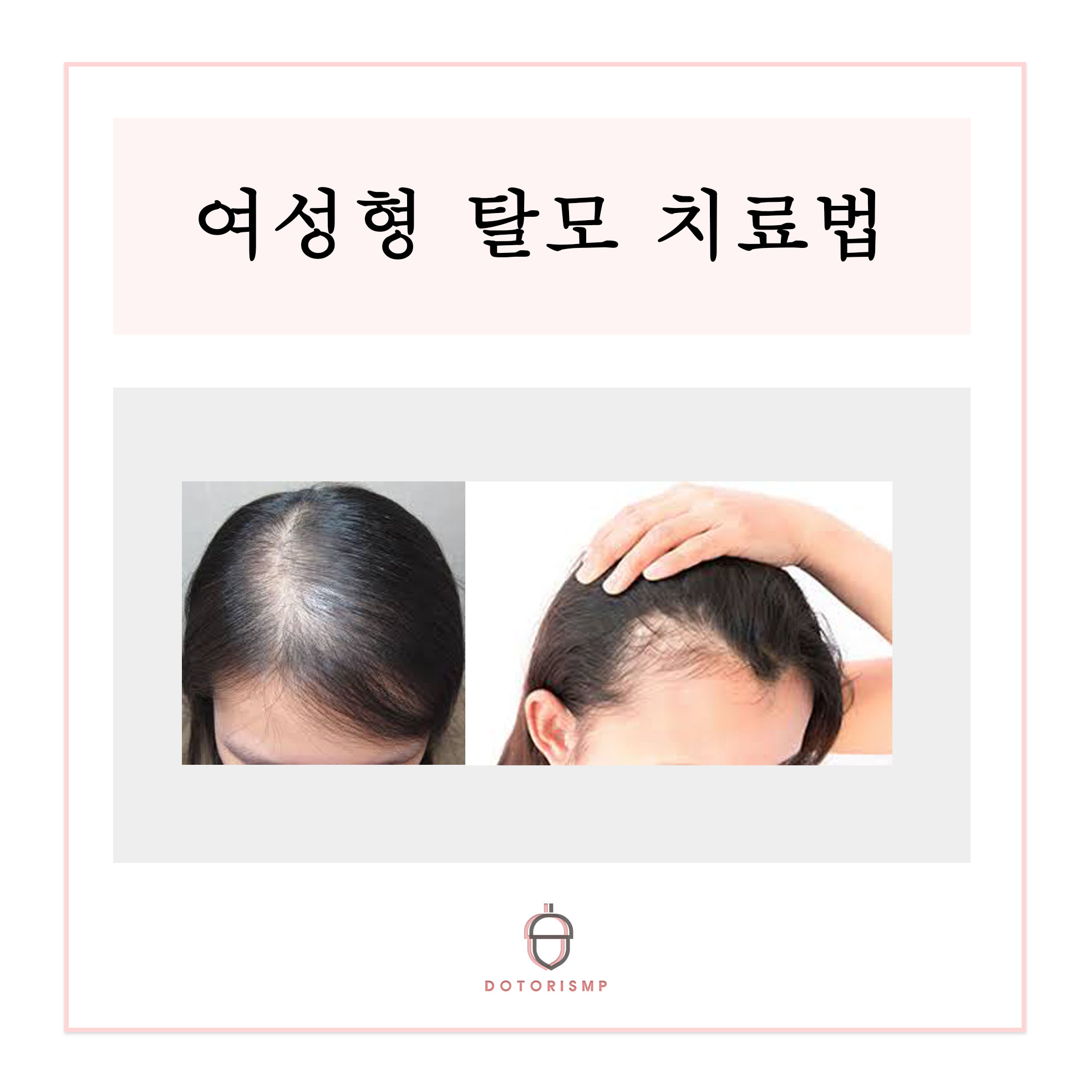  여성형 탈모 치료법 총 정리