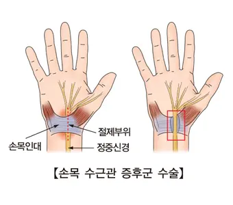 손목- 터널-중후군-손목-통증-자가진단