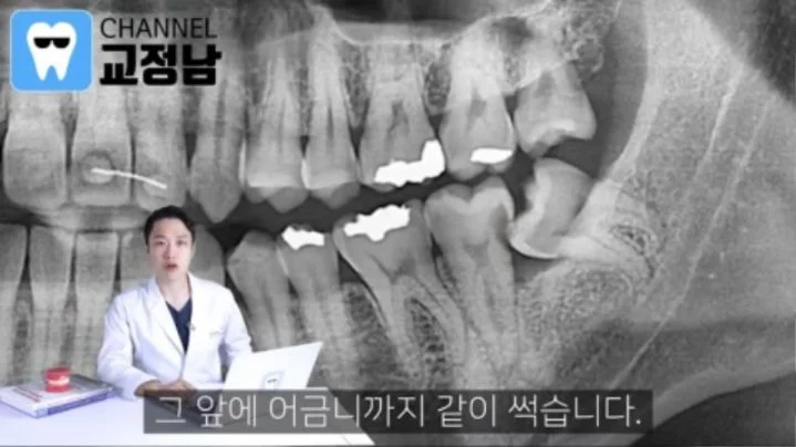  누운 사랑니를 반드시 뽑아야 하는 이유