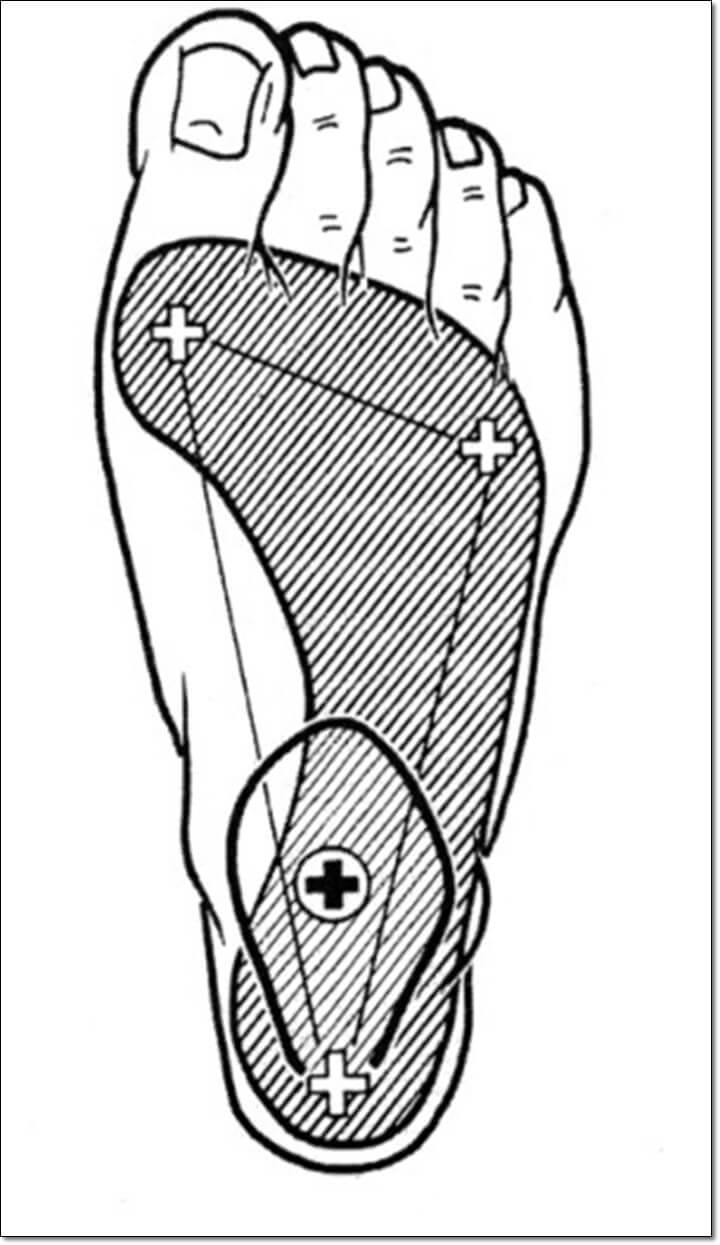 발바닥 체중 지지점을 보여주는 그림