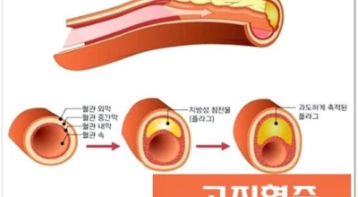 고혈압 이미지