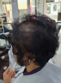 중년 여성 탈모 갱년기 때문 염색 파마