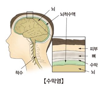 뇌수막염 증상