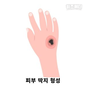 수족구 격리기간