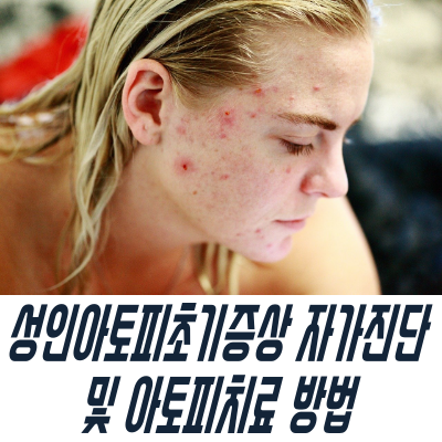  성인아토피초기증상 자가진단 및 아토피치료 방법