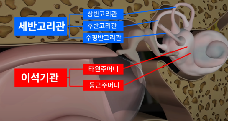 이석증 관련사진