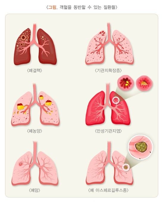 각혈의 원인