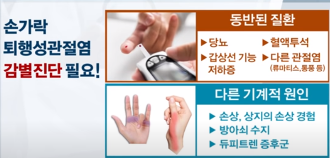출처: 서울대병원TV(손가락 퇴행성 관절염 동반질환)