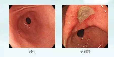 위궤양