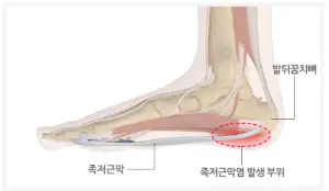 족저근막염이란?-썸네일-이미지사진