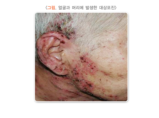 대상 포진 초기