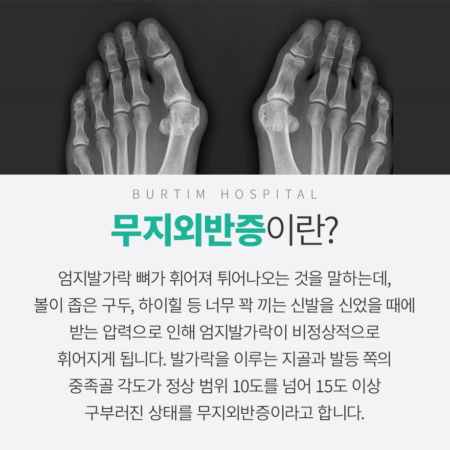 외반 모지는 또한 무릎과 척추에 영향을 미칩니다 6