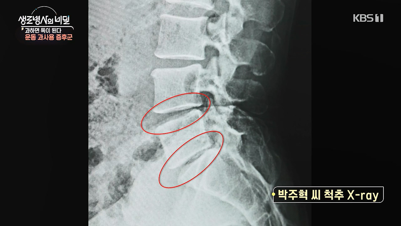생로병사의 비밀.E918.240704p-NEXT.mp4_20240704_201613.059.jpg