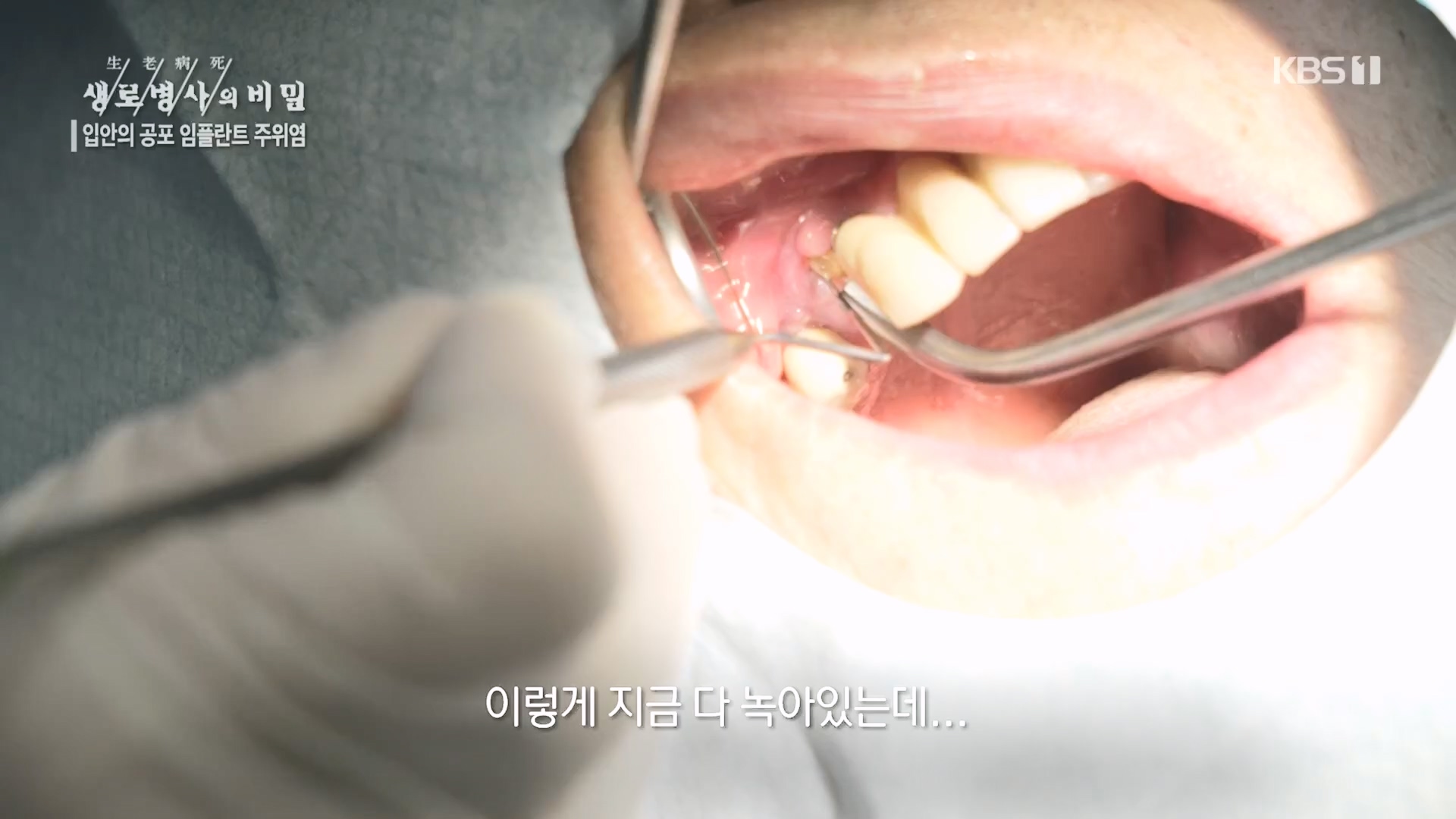 생로병사의 비밀.E890.231213p.H264-F1RST.mp4_20231214_201916.606.jpg