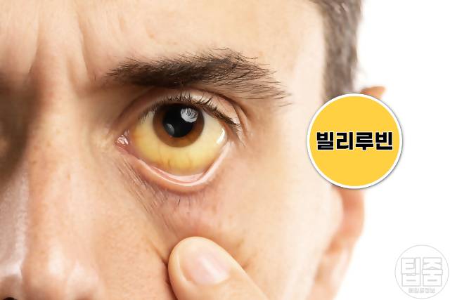 간이 안좋으면 나타나는 증상,눈흰자 노란색 황달,간경화 증상,간이안좋은증상,팁줌