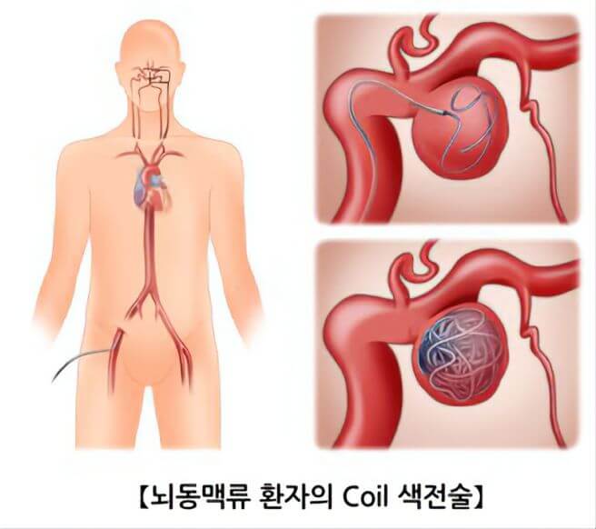 뇌동맥류 증상